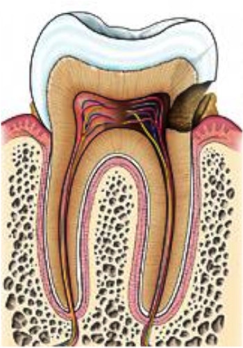 caries dentaires 3 